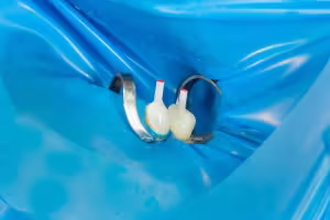 Post-Endodontic Restoration Gains Strategic Focus in Dentistry for Enhanced Longevity and Structural Integrity
