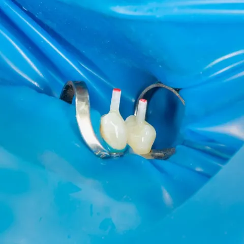 Post-Endodontic Restoration Gains Strategic Focus in Dentistry for Enhanced Longevity and Structural Integrity