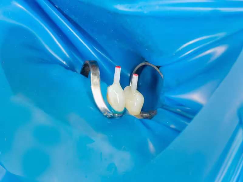 Post-Endodontic Restoration Gains Strategic Focus in Dentistry for Enhanced Longevity and Structural Integrity